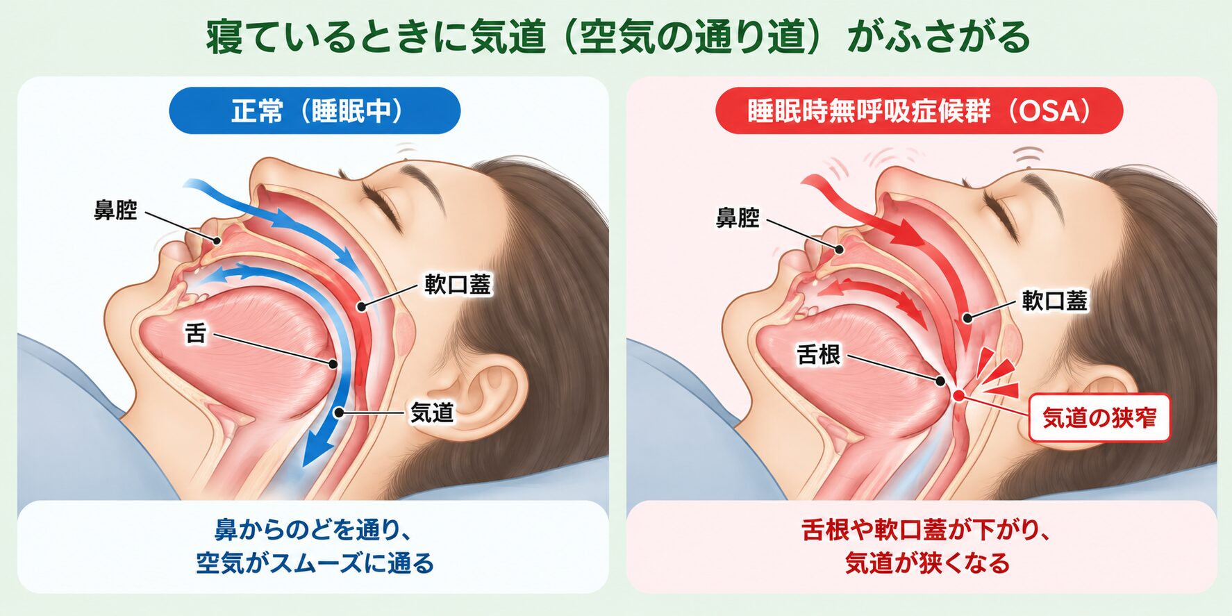正常な気道と閉塞性睡眠時無呼吸症候群（OSA）の比較